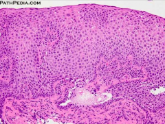 Eosinófilos en mucosa (y luego neutrófilos).
Hiperplasia de zona basal (20% de grosor epitelial se vuelve basal).
Herniación de lámina propia.

 


Esofagitis por reflujo, es la causa principal de esofagitis.