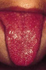 1. a high index of suspicion is important
2. blood cultures are often negative
3. cultures may be taken from the suspected source, but the diagnosis is primary clinical
* pic = strawberry tongue- may be seen in TSS, scarlet fever and kawasaki d...