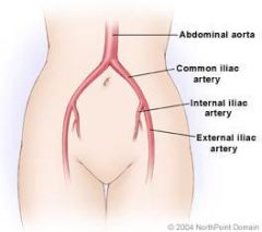 External (EIA) and Internal (IIA) Iliac Artery