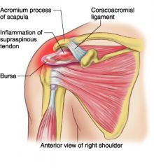 it can pinch suprascapular nerve
 
OR
 
Type 3 acromion process can tear the supraspinatus muscle