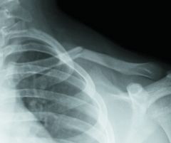 weakest part of clavicle is middle third
 
the way it changes direction & shape causes weakness
 
common fracture is a greenstick fracture in adolescents