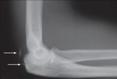 40yo competitive wtlifter felt a painful pop in his elbow while performing a bench press. His lat xray in Fig A. An MRI is to show ? 1-Distal biceps tend rupture;
2-Brachialis mus rupture; 3-Lat ulnar collateral lig tear; 
4-Med ulnar collateral...