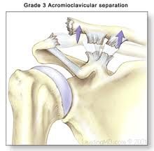 Grade III AC jt separations, surgical tx results in which of the following when compared to non-op tx? 1-Faster return to play; 2-Inc ROM; 3-Inc func rotator cuff strength; 4-Dec funt rotator cuff strength; 5-Higher compln rate