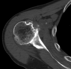 rev TSA is best Tx-> cuff tear arthropathy, Hemiarthro <outcomes to TSA’s for glenoihumeral DJD due to painful articulation of the humeral component on arthritic glenoid, #1 restriction p/(TSA) is passive ER + active IR, to protect the subscapul...