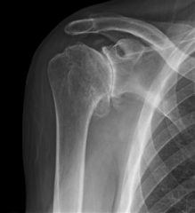 65yo M c/o debilitating pain, crepitus in his shoulder. Active for elevation=120 deg, ER strength is good. Fig. Which tx give best outcome in 3 yrs? 1-Arthroscopic capsular release; 2-Hum head arthroplasty w/glenoid BG followed by staged glenoid c...