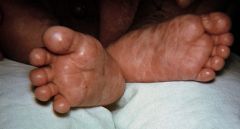 Early sign of congenital syphilis?
