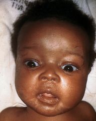 Late sign of congenital syphilis?