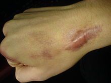 Irregular, raised lesion resulting from scar tissue hypertrophy (follows trauma to skin, especially in African-Americans) 

(e.g., T. pertenue [yaws])