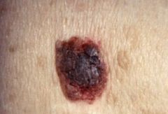 Flat, greasy, pigmented squamous epithelial proliferation with keratin-filled cysts (horn cysts).  Looks "pasted on." Lesions occur on head, trunk, and extremities.  Common benign neoplasm of older persons.  

Sign of Leser-Trelat - sudden appearance of