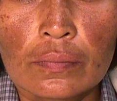 "Mask of pregnancy" - hyperpigmentation associated with pregnancy or OCP use.