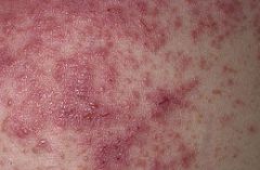 Pruritic papules and vesicles.  Deposits of IgA at the tips of dermal papillae.  Associated with celiac disease.