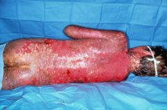 Characterized by fever, bulla formation and necrosis, sloughing of skin, and a high mortality rate.  Usually associated with adverse drug reaction.  A more severe form of Stevens-Johnson syndrome is known as toxic epidermal necrolysis.