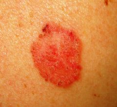 Very common.  Associated with excessive exposure to sunlight and arsenic exposure.  Commonly appear on hands and face.  Locally invasive, but rarely metastasizes.  Ulcerative red lesion.  Associated with chronic draining sinuses.  Histopathology: keratin 