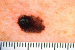 Common tumor with significant risk of metastasis.  S-100 tumor marker.  Associated with sunlight exposure; fair-skinned persons are at increased risk.  Depth of tumor correlates with risk of metastasis.  Dysplastic nevus (atypical mole) is a precursor to 