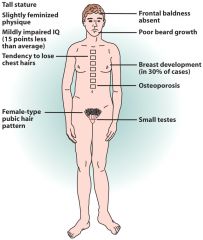 Male, XXY, 1:850
Testicular atrophy, eunuchoid body shape, tall, long extremities, gynecomastia, female hair distribution. May present with developmental delay.  Presence of inactivated X chromosome (Barr body).  Common cause of hypogonadism seen in infe