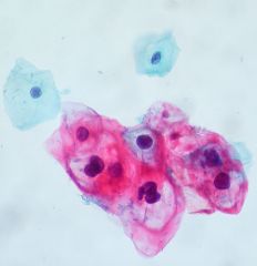 Koilocytes - note the wrinkled, "raisinoid" nuclei, some of which have clearing or a perinuclear halo.