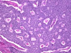 Secretes estrogen --> precocious puberty (kids).
Can cause endometrial hyperplasia or carcinoma in adults.
Call-Exner bodies - small follicles filled with eosinophilic secretions (see picture).  
Abnormal uterine bleeding.