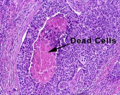 Ductal, caseous necrosis.  Subtype of DCIS.