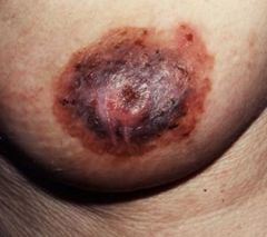 Eczematous patches on nipple.  Paget cells = large cells in epidermis with clear halo.

Suggests underlying carcinoma.  Also seen on vulva.