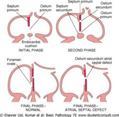 1. Foramen primum narrows as septum primum grows toward endocardial cushions.

2. Perforations in septum primum form foramen secundum (foramen primum disappears).

3. Foramen secundum maintains right-to-left shunt as septum secundum begins to grow.


