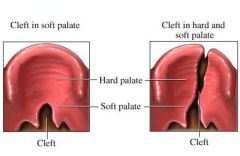 Cleft lip - failure of fusion of the maxillary and medial nasal processes (formation of primary palate)

Cleft palate - failure of fusion of the lateral palatine processes, the nasal septum, and/or the median palatine process (formation of secondary pal