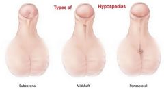 abnormal opening of penile urethra on inferior (ventral) side of penis due to failure of urethral folds to close

Hypospadias is more common than epispadias.
Fix hypospadias to prevent UTIs.