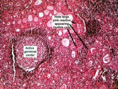 Most common cause of hypothyroidism; an autoimmune disorder (antimicrosomal, antithyroglobulin antibodies).  Associated with HLA-DR5.  Increased risk of non-Hodgkin's lymphoma.

Histology: Hurthle cells (see picture), lymphocytic infiltrate with germina