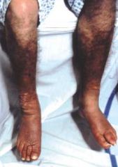 An autoimmune hyperthyroidism with thyroid-stimulating/TSH receptor antibodies.  Ophthalmopathy (proptosis, EOM swelling), pretibial myxedema (see picture), increase in connective tissue deposition, diffuse goiter.  Often presents during stress (e.g., chi
