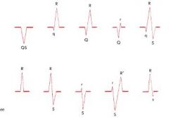 initial negative deflection is Q wave
the first positive deflection is R wave
a negative deflection following is S wave

If the entire complex is positive = R wave, if entire complex is negative = QS wave

Extra waves are R' if positive, S' ...