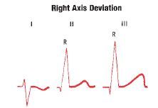 Axis of 100 or more positive (vertical) to +180

When leads II and III show tall R waves of equal height, QRS axis must be +90 
If leads II and III show tall R waves and the R wave in lead III exceeds lead II = RAD is present
(also lead I show...