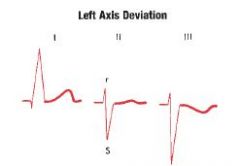 Axis of -30 or more negative ( horizontal) to -90

Lead II shows an RS complex with S wave deeper than R wave is tall
Lead I shows a tall R wave
Lead III shows a deep S wave

Another option: positive in Lead I, negative in Lead aVF