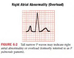 may cause increase in voltage of P wave

Normally the P wave is less than or equal to 2.5mm in amplitude; less than 0.12 seconds in width

With RAA, the width of P wave is normal ( <0.12) but the height exceeds 2.5mm = tall P waves

Tall nar...