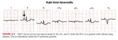 Dx can be made by finding an abnormally tall P wave in leads II, III, aVF or V1