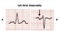 LAA should prolong the duration of atrial depolarization = abnormally wide P wave ( >0.12)
Amplitude may be normal or increased

the P waves can sometimes have a humped or notched appearance
Lead V1 sometimes shows a biphasic P wave