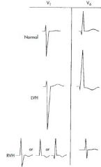 Right chest leads (V1) show tall positive R waves
Along with tall R waves, RVH also produces RAD and T wave inversions in right to mid-chest leads (right ventricular "strain" pattern)