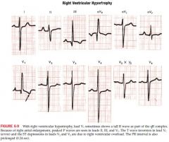 congential heart disease (pulmonic stenosis, atrial septal defect, tetralogy of Fallot) or lung disease that often causes RAA also causes RVH; so signs of RVH are sometimes accompanied by tall P waves 

The presence of RBBB by itself does not in...