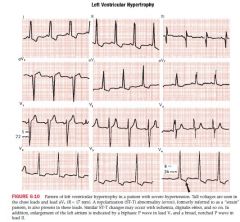 abnormally tall positive R waves seen in Left chest leads, and abnormally deep negative S waves seen in Right chest leads

If the sum of depth of the S wave in V1 and the hight of the R wave in V5 or V6 exceeds 35mm, LVH should be considered

...