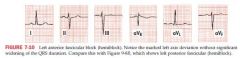 A block in either fascicle of the LBB system; partial block 

does not widen the QRS complex; affects axis instead

Left anterior hemiblock results in marked LAD (-45 or more negative); S wave in aVF equals or exceeds R in lead I; aVL shows a ...