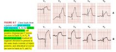 acute phase: ST elevations +\- hyperacute T waves in certain leads
evolving phase: occurs hours or days later with deep T wave inversions in leads that previously shows ST elevations (ST returns to baseline)