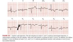 Characteristic feature of anterior wall is loss of normal R wave progression  with pathological Q waves in the chest leads, I and aVL with inverted T waves
caused by occlusion of left anterior descending coronary artery or  left circumflex corona...