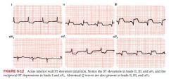 abnormal Q waves in leads II, III, aVF
generally caused by occlusion of Right coronary artery and less commonly by left circumflex coronary obstruction