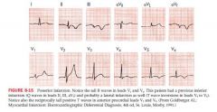 Tall R waves and ST depressions may occur in V1 and V2
can extend to lateral wall producing changes in V6, or to inferior wall producing changes in II, III, and aVF