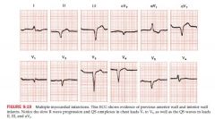 Old MIs have Q waves but no ST elevation or depression

New Mis have Q waves with associated elevation or depression