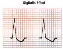 Digitalis shortens repolarization time in ventricles = shortens QT interval and associated with scooping of the ST interval 

Quinidine, procainamide, and disopyramide are antiarrhythmic drugs but prolong ventricular repolarization due to blocki...