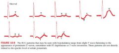 ST depressions with prominent U waves and prolinged repolarization
Flattened T waves