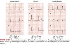 ventricular repolarization is shortened by hypercalcemia
ventricular repolarization is lengthened by hypocalcemia

Hyper: Short QT and short ST, and T wave appeasr to take off right from end of QRS; may lead to coma or death; AMS
Hypo: long QT...