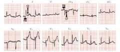 early phase: ST elevations seen in both anterior and inferior leads with PR depression (V5, V6)

elevation of PR in aVF and depression of ST
T wave inversions may follow ST elevations
No Q waves