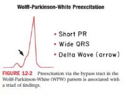 QRS widened dt early stimulation, PR is shortened
upstroke of QRS = delta wave tat is also slurred or notched
- can be mistaken for BBB or MI

Pts are prone to arrhythmias, esp paroxysmal supraventricular tachy, can develop afib