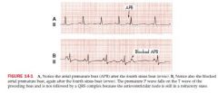 Results from ectopic stimuli; somewhere in the R or L atrium but not SA node
QRS complex is not affected by APBs or JPBs

Atrial depolarization is premature, occurring before the next normal P wave

The P wave of the QRS complex that follows ...