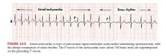 defined as three or more consecutive APBs
Most episodes involve an ectopic non sinus pacemaker located in either L or R atrium that fires automatically in a rapid way

Atrial rate may be as high as 200 bpm or faster